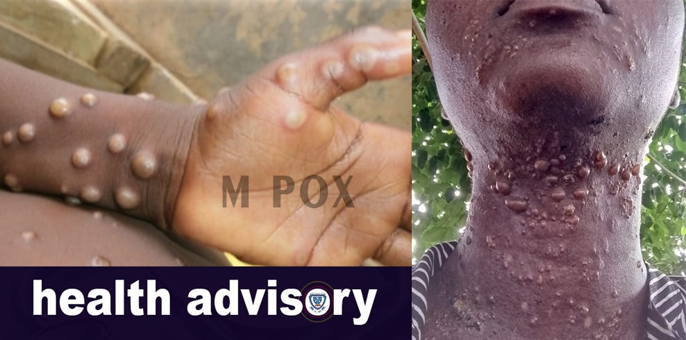 Ful Medical Center Issues Health Advisory On Monkey Pox