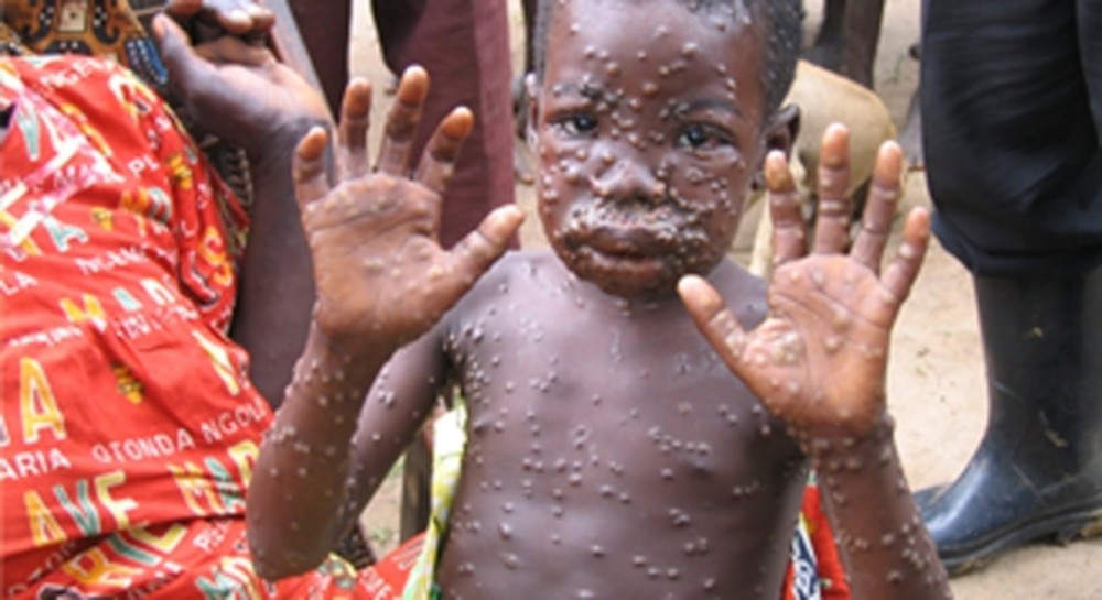 Public Health Advisory For Monkeypox Viral Disease From The University Health Services, Ful